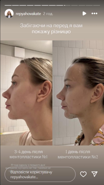 Дружина Павліка зробила четверту пластику та заявила, що вона буде останньою