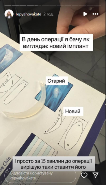 Дружина Павліка зробила четверту пластику та заявила, що вона буде останньою