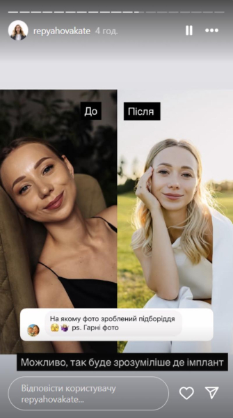 Репяхова розповіла про невдалу пластику і показала фото до та після