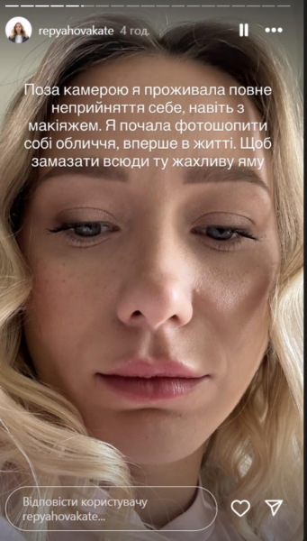 Репяхова розповіла про невдалу пластику і показала фото до та після