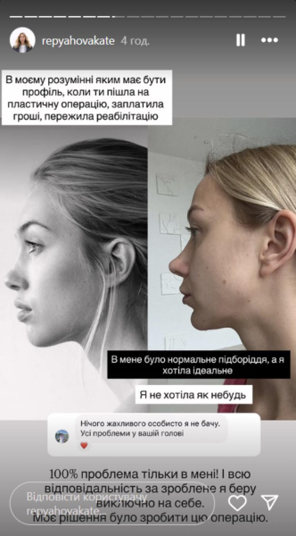 Репяхова розповіла про невдалу пластику і показала фото до та після