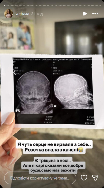 Донька блогерки Верби отримала серйозну травму після падіння з гойдалки